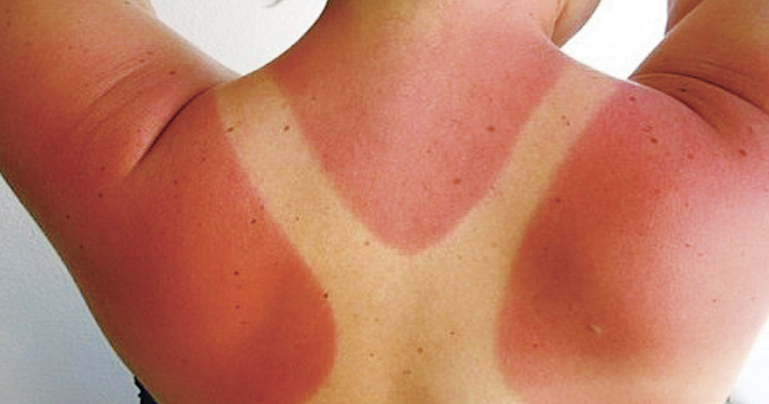 Dermatologo lancia l’allarme: sole alle Canarie, rischi per la pelle