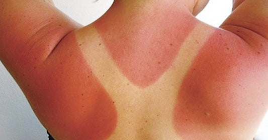 Dermatologo lancia l’allarme: sole alle Canarie, rischi per la pelle