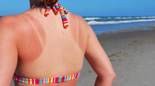 Canarie in allerta "rischio estremo" per le radiazioni solari UV